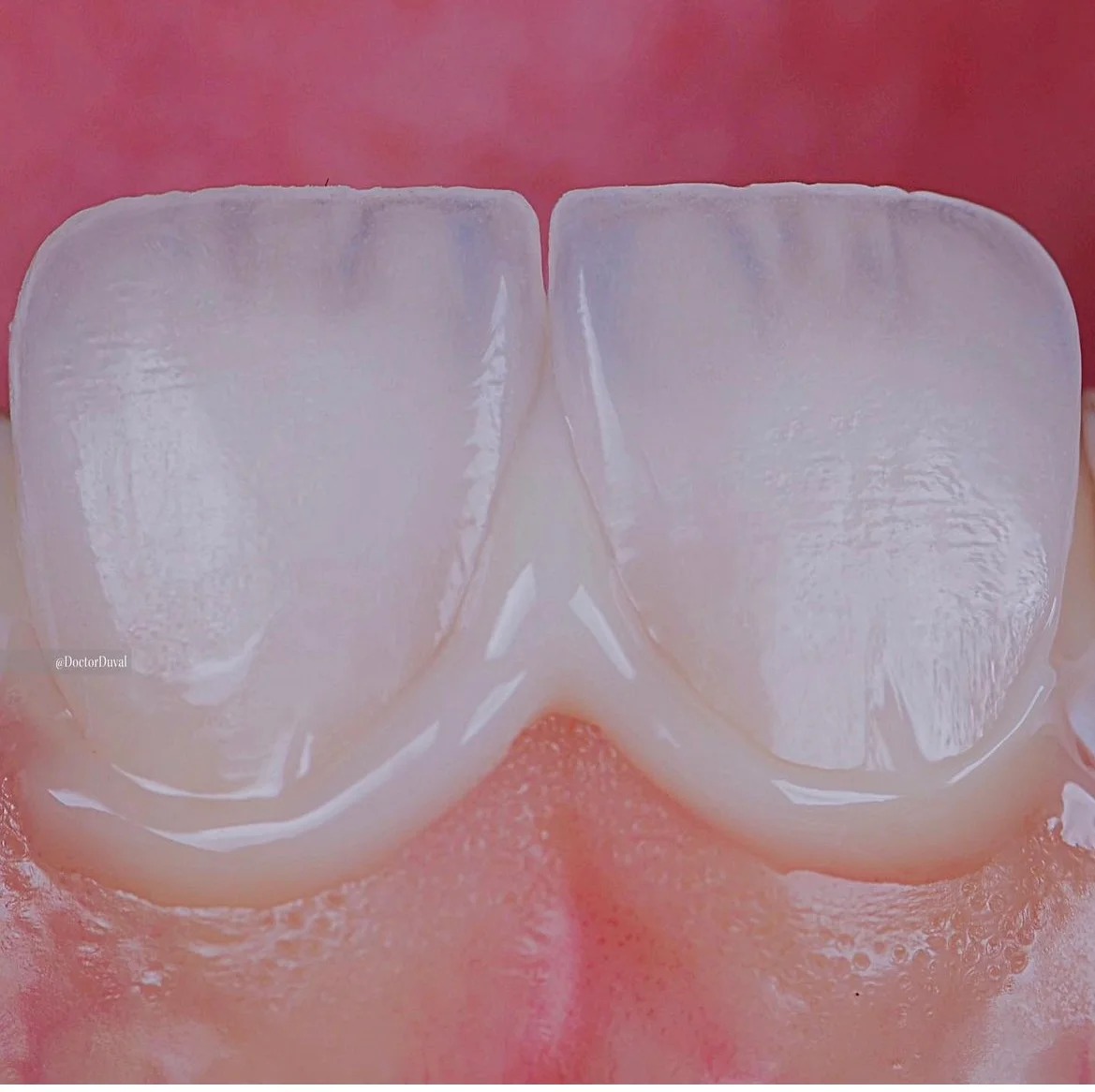 After treatment: close-up view of custom-crafted porcelain restorations demonstrating exceptional translucency, surface texture, and vitality that seamlessly mimics healthy natural teeth.
